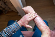  Kenali 8 Jenis Psoriasis dan Cara Menanganinya 