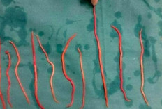  Askariasis, Infeksi Disebabkan Cacing Gelang